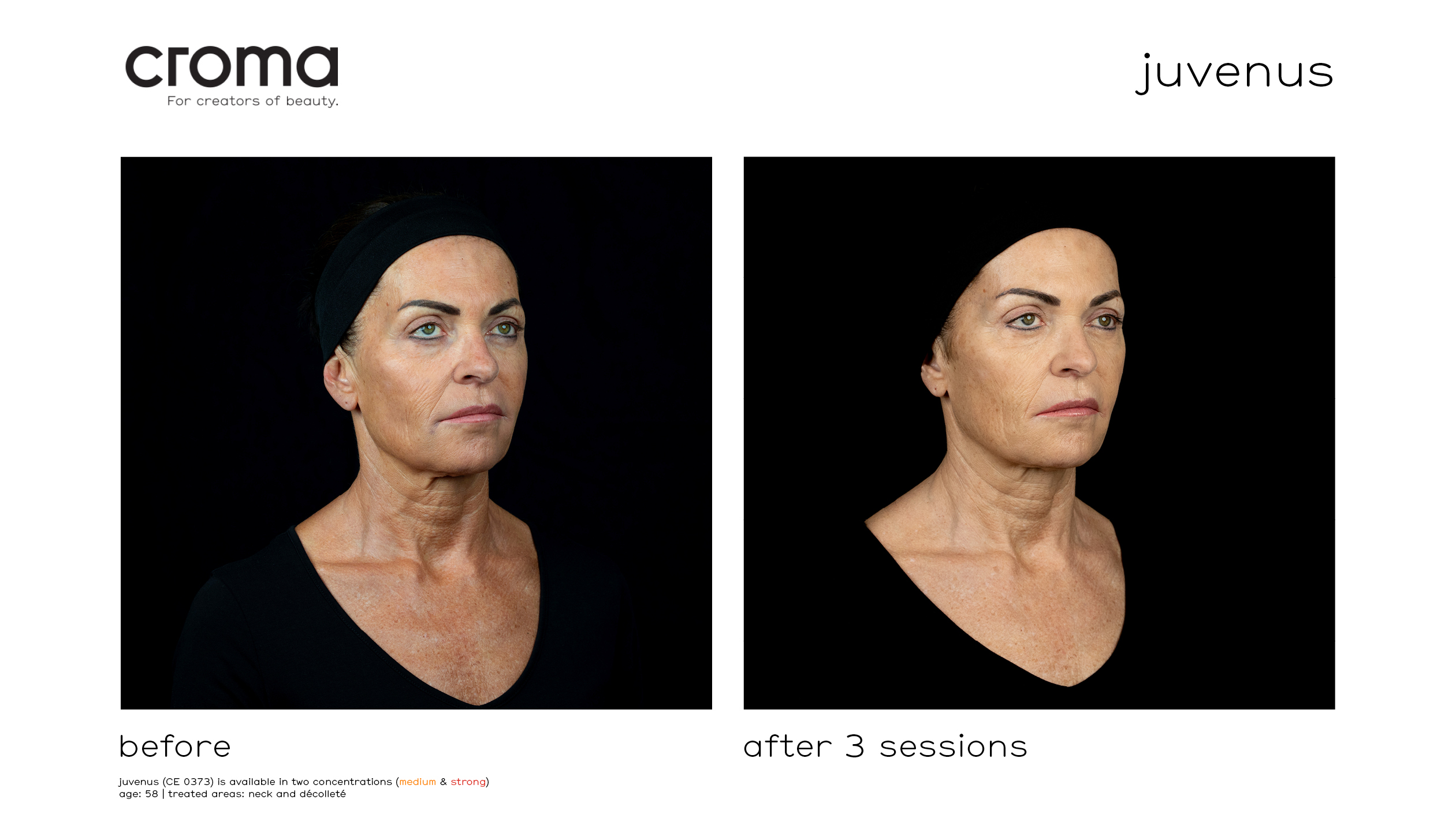before-after3sessions-juvenus-p1_ppt_frontal-right