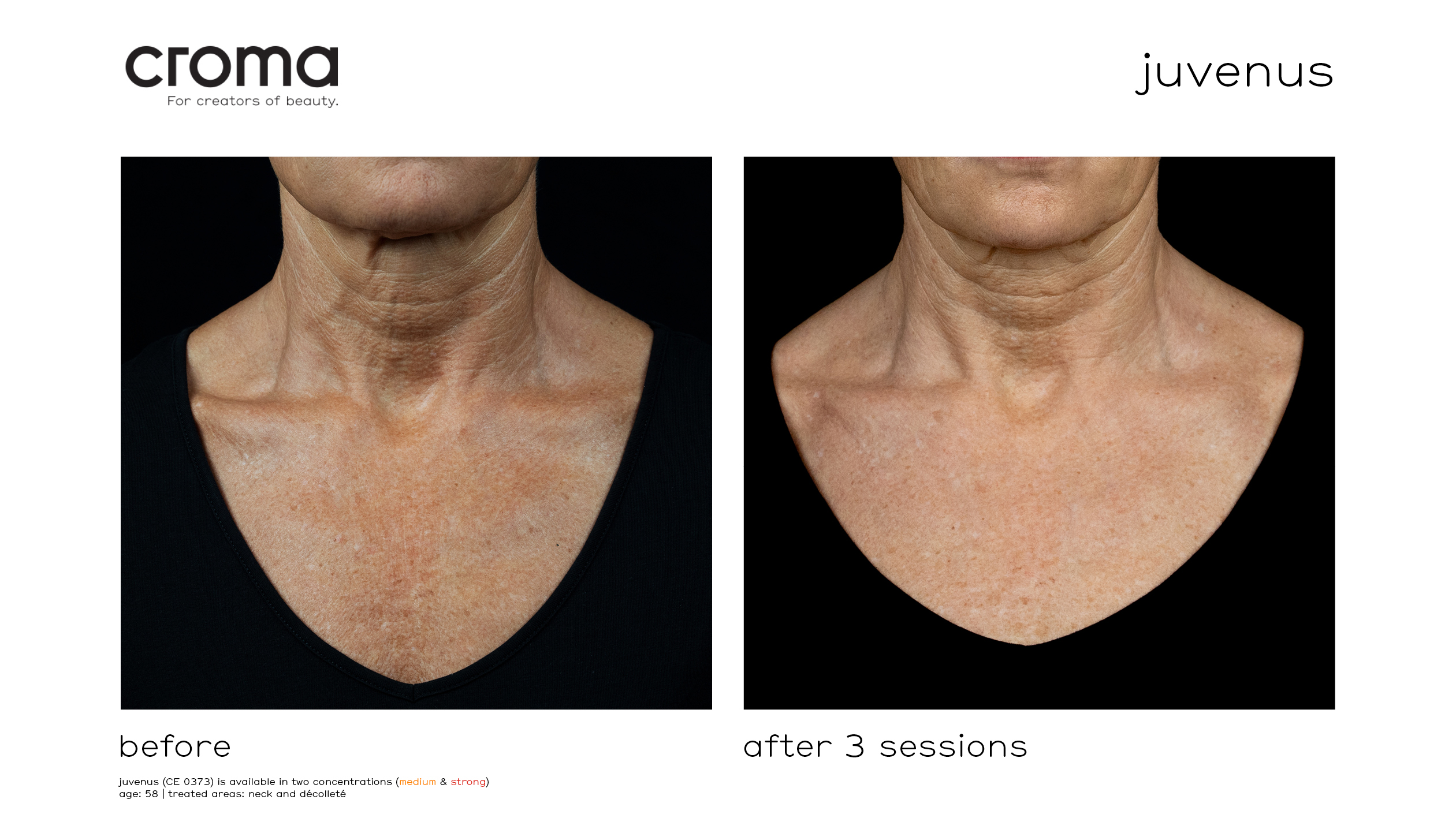 before-after3sessions-juvenus-p1_ppt_frontal